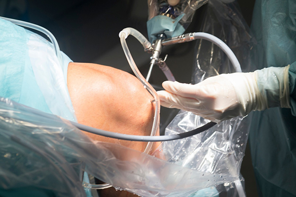 Can Knee Arthroscopy in Houston, TX Help You Avoid Knee Replacement Surgery?
